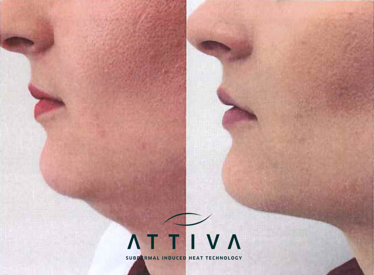 ATTIVA Chin Treatment-PharoDerma aesthetic products for health care